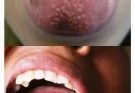 😱If you have these little balls on your tongue, worry, it’s a sign of…See more