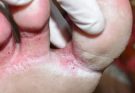 Looks like a infection between my toes…See more