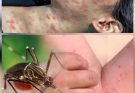 ALERT: New Disease Outbreak in China — Over 7,000 Cases Reported, Symptoms and Risks Revealed…See more