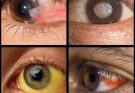 Signs in your EYES that indicate…See more
