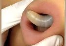 Larvae found in a young woman…See more