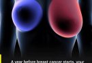 Breast cancer: 4 early signs every woman…See more